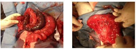 Intraop Foreign Body Resection Anastomosis 