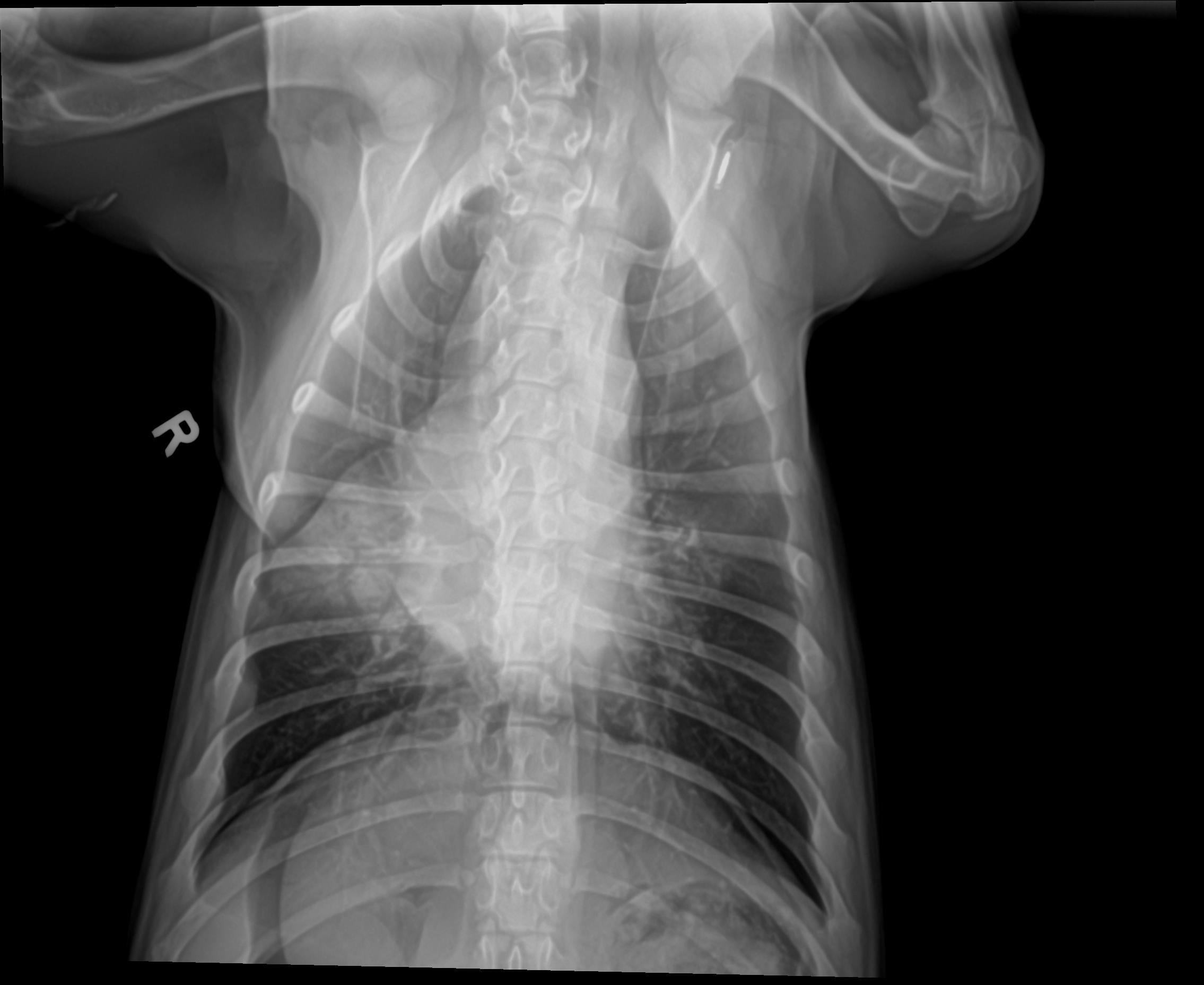 Moe Radiograph Before Laser Therapy Thorax VD 2.5.26