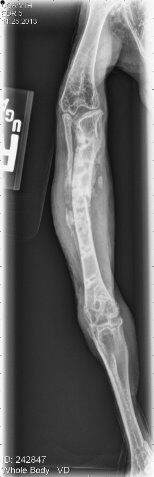 Red-tailed hawk with a tibiotarsus fracture 19 days after surgery, post 8-10 laser treatments